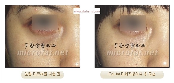 [두한성형외과 경쟁력 눈밑성형] - [다크써클 치료 전후 관리사항] 관련 이미지 22