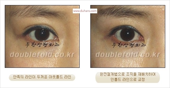 [두한성형외과 경쟁력 눈성형] - [완전절개법(Full incision method)의 재수술 과정] 관련 이미지 9