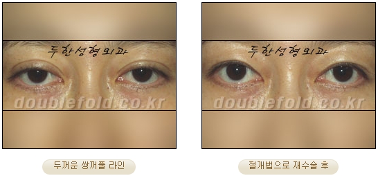 [Duhan Plastic Surgery Double Eyelid Revision Surgery] - [Ptosis Correction Surgery] image 43