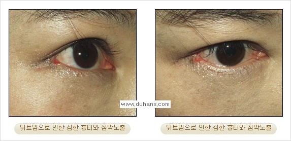 [두한성형외과 경쟁력 쌍꺼풀 재수술, 극한 눈재수술] - [뒤트임 수술의 부작용 안내] 관련 이미지 11
