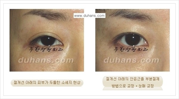 [두한성형외과 경쟁력 쌍꺼풀 재수술(극한 재수술)] - [절개선 아래가 두툼한 소세지 현상 안내] 관련 이미지 4