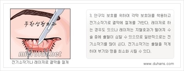 [두한성형외과 경쟁력 지방제거] - [눈밑(눈위)지방제거, 눈꺼풀(윗눈꺼풀)지방제거 안내 ①] 관련 이미지 7