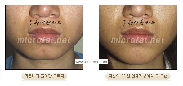 [두한성형외과의 경쟁력 미세지방이식] - [무턱교정 - 턱 미세지방이식 안내 2.] 관련 이미지 9