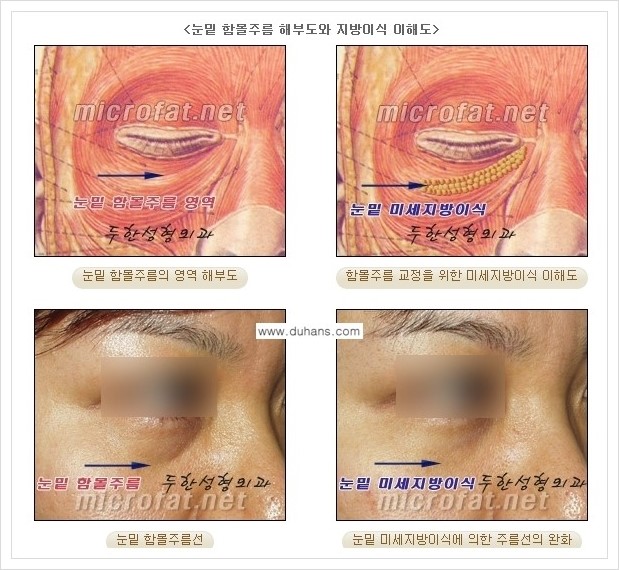 [두한성형외과 경쟁력 눈밑성형] - [눈밑 다크써클, 눈밑 주름의 교정 안내 1.] 관련 이미지 16
