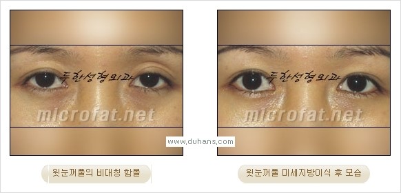 [두한성형외과 경쟁력 미세지방이식] - [꺼진(함몰된) 윗눈꺼풀 미세지방이식] 관련 이미지 12