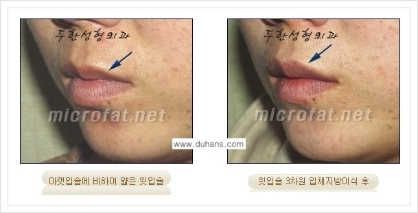 [두한성형외과 경쟁력 미세지방이식] - [입술 미세지방이식 안내 2.] 관련 이미지 11