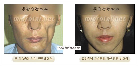 [두한성형외과 경쟁력 윤곽성형] - [볼, 볼살 지방이식] 관련 이미지 5