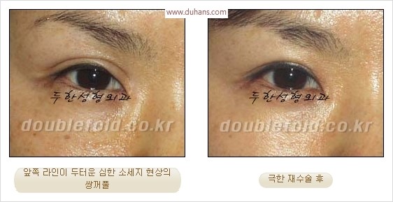 [두한성형외과 경쟁력 눈성형] - [극한 재수술, 함몰된 눈꺼풀 라인교정, 안검하수(졸리운 눈매)] 관련 이미지 5