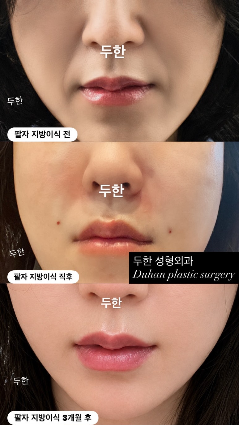 Nasolabial Fold Fat Grafting: How Can You Improve Fat Retention and Naturalness? image 3