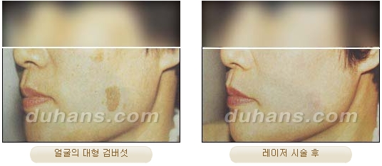 Duhan Plastic Surgery Laser Treatment - Mole Removal, Spot Removal, Melasma, Blemishes, Hyperpigmentation, Skin Tone Improvement, Elasticity Improvement, Skin Texture Improvement image 37
