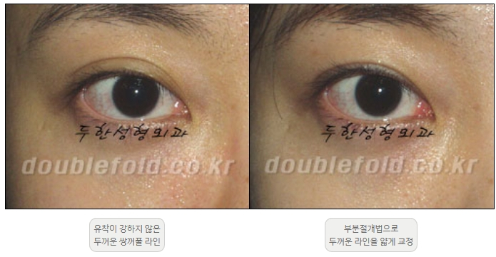 [Duhan Plastic Surgery Double Eyelid Revision] - [Thick Double Eyelid Line] image 31