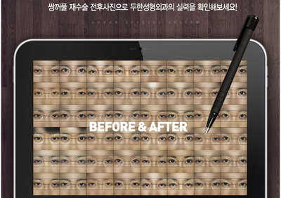 [눈성형잘하는곳 두한성형외과] - [짝짝이눈, 쌍꺼풀짝짝이, 쌍수절개, 쌍꺼풀수술] 관련 이미지 3