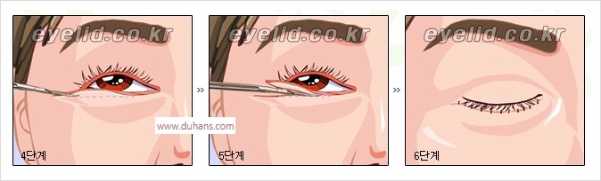 [두한성형외과 경쟁력 안검성형] - [눈밑주름 제거수술] 관련 이미지 4