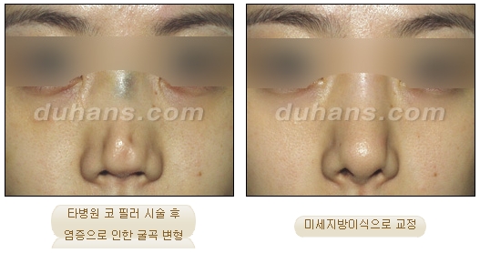 Duhan Plastic Surgery Wrinkle Improvement - Wrinkle Fillers, Juvederm image 14