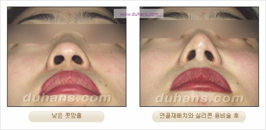 [두한성형외과 경쟁력 코성형 리더] - [자연스럽고 오똑한 콧망울! 코성형 방법]​ 관련 이미지 17