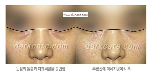 [두한성형외과 경쟁력 눈밑성형] - [눈밑 안와지방 돌출의 무통마취 무흉터 눈밑지방제거 안내] 관련 이미지 12