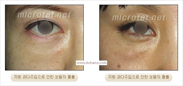 [두한성형외과 경쟁력 미세지방이식] - [미세지방이식, 자가지방이식, 지방이식, 지방주입에 대한 잘못된 정보] 관련 이미지 18