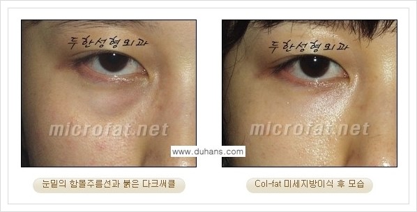 [두한성형외과 경쟁력 눈밑성형] - [눈밑 다크써클과 눈밑 함몰주름의 최적화 교정방법 안내] 관련 이미지 29