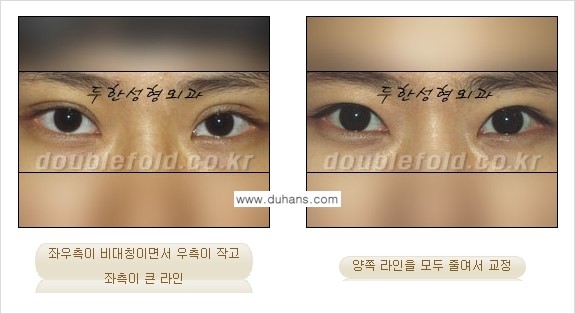 [두한성형외과 경쟁력 눈성형] - [비대칭(짝짝이) 쌍꺼풀 라인 교정 안내 ②] 관련 이미지 7