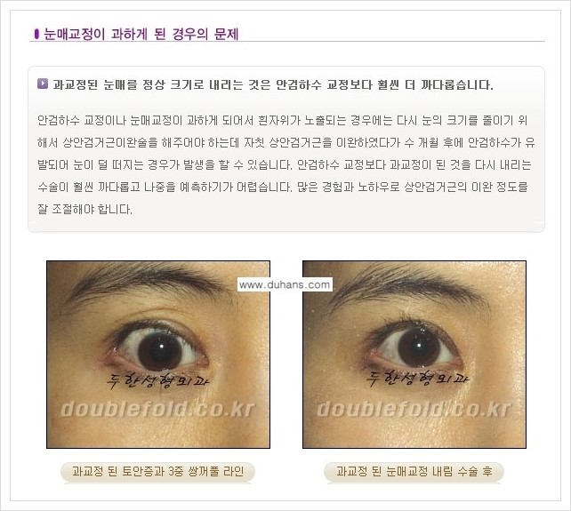[두한성형외과 경쟁력 쌍꺼풀 재수술, 극한 재수술] - [재수술에서 극복해야 할 극한의 상황과 문제들 안내] 관련 이미지 9