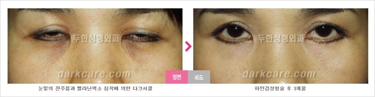 두한성형외과 눈밑수술 - 다크서클 수술 전후 관리 안내 관련 이미지 91