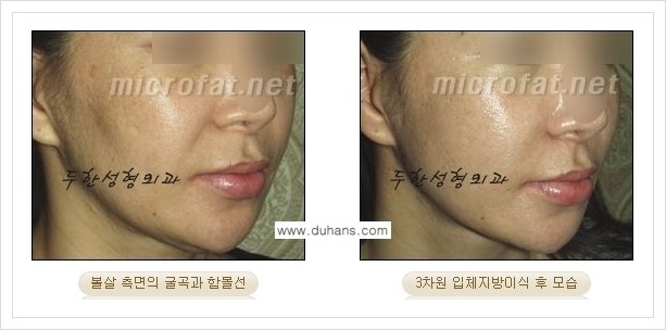 [두한성형외과 경쟁력 볼살지방이식] - [사각턱의 경우, 측면 볼살의 함몰선, 안면비대칭, 남성 야윈볼살 안내] 관련 이미지 5