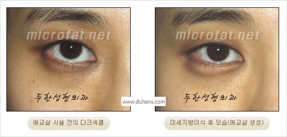 [두한성형외과 경쟁력 미세지방이식] - [애교살 필러 시술의 부작용 교정] 관련 이미지 11