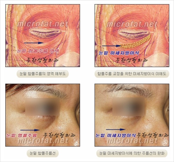 [두한성형외과 경쟁력 눈밑성형 리더] - [윗눈꺼풀 지방제거, 눈밑지방제거, 눈밑지방재배치, 눈밑지방이식 안내] 관련 이미지 21