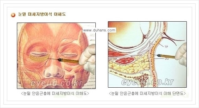 [두한성형외과 경쟁력 눈밑성형] - [눈밑 미세지방이식으로 다크써클 치료] 관련 이미지 2
