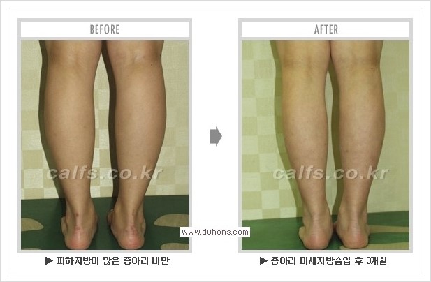 [두한성형외과 경쟁력 멀티종아리성형] - [종아리성형 방법별 전후 주의사항] 관련 이미지 27