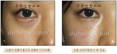 두한성형외과 눈밑성형 - 눈밑지방제거, 눈밑주름, 눈밑지방재배치 관련 이미지 87