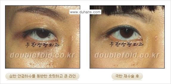[두한성형외과 NO.1 경쟁력 눈성형] - [일반 쌍꺼풀 재수술과 극한 눈(쌍꺼풀) 재수술과의 차이점] 관련 이미지 8