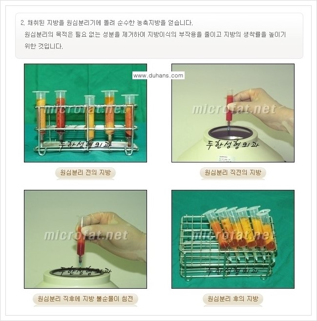 ⁠⁠[두한성형외과 경쟁력 볼살지방이식] - [심하게 야윈 주름이 있는 얼굴, 역삼각형 협소한 얼굴, 광대뼈가 돌출되어 보이는 경우 안내] 관련 이미지 6