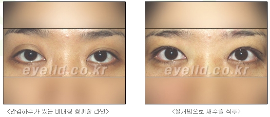 Duhan Plastic Surgery Ophthalmic Reoperation - What Is a Successful Double Eyelid Revision Surgery? image 2