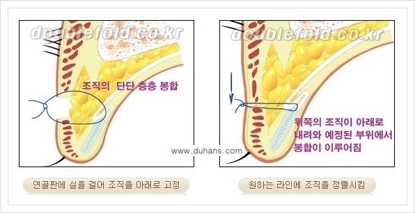 [두한성형외과 경쟁력 쌍꺼풀 재수술] - [두껍고 어색한 라인 교정하는 방법 안내 2.] 관련 이미지 3