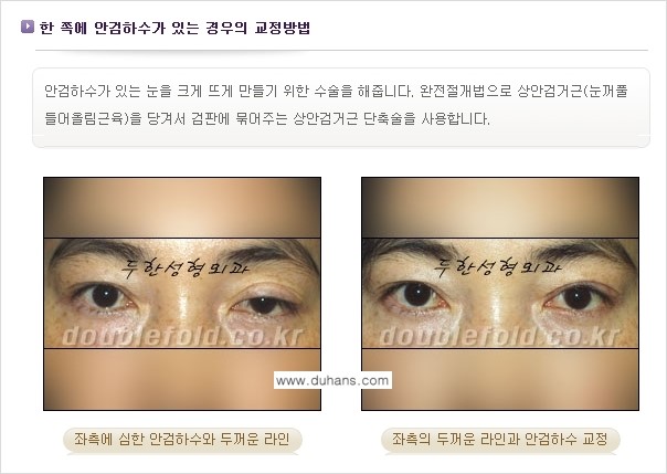 [두한성형외과 경쟁력 쌍꺼풀 재수술] - [비대칭(짝짝이) 쌍꺼풀 라인 교정하는 방법 안내 ①] 관련 이미지 10