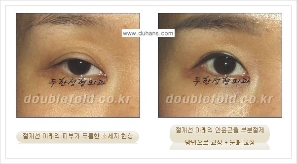 [두한성형외과 경쟁력 쌍꺼풀 재수술, 극한 재수술] - [쌍꺼풀 절개선 아래가 두툼한 소세지 쌍꺼풀의 교정 안내] 관련 이미지 3