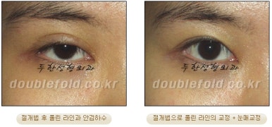 Double Eyelid Revision Surgery at Duhan Plastic Surgery Clinic - Asymmetric Double Eyelids, Pseudoptosis, and Lateral/Lower Canthoplasty image 36