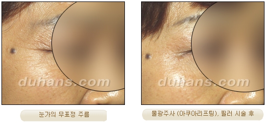 Duhan Plastic Surgery Wrinkle Improvement - Wrinkle Fillers, Juvederm image 11