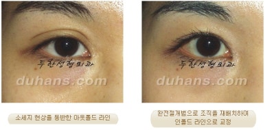 Best Place for Revision Eyelid Surgery, Duhan Plastic Surgery - Lowering Double Eyelid Line image 18