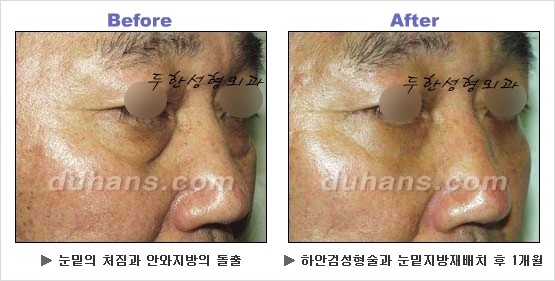 [두한성형외과 경쟁력 동안성형 리더] - ​[미간주름, 이마주름, 안검성형, 이마거상술, 눈썹거상술] 관련 이미지 90