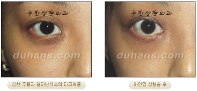 Blepharoplasty, Duhan Plastic Surgery - Upper and Lower Eyelids image 39