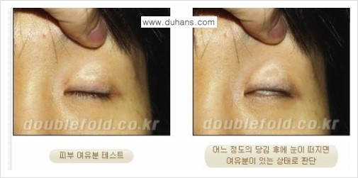 [두한성형외과 경쟁력 쌍꺼풀 재수술] - [쌍꺼풀 재수술의 대상과 해당 쌍꺼풀 재수술 방법 안내] 관련 이미지 2