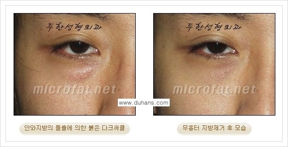 [두한성형외과 경쟁력 눈밑성형] - [눈밑지방제거, 눈위지방제거 안내 2.] 관련 이미지 19