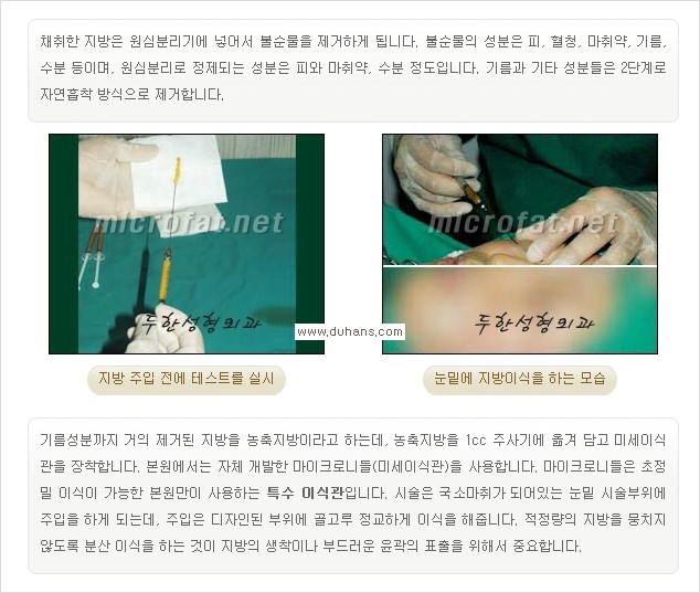 [두한성형외과 경쟁력 눈밑성형] - [눈밑 애교살 시술을 위한 미세지방이식] 관련 이미지 5