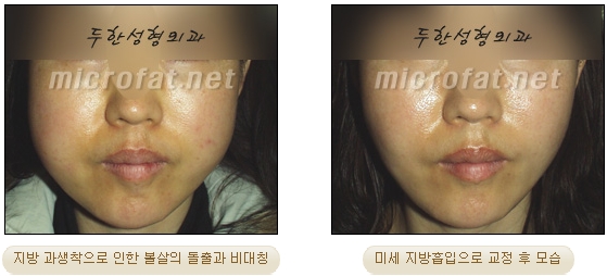 얼굴지방이식 두한성형외과 - 볼지방이식 관련 이미지 43