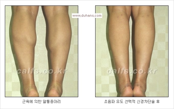 [두한성형외과 경쟁력 멀티종아리성형] -  [종아리 축소술의 여러 가지 종류] 관련 이미지 23