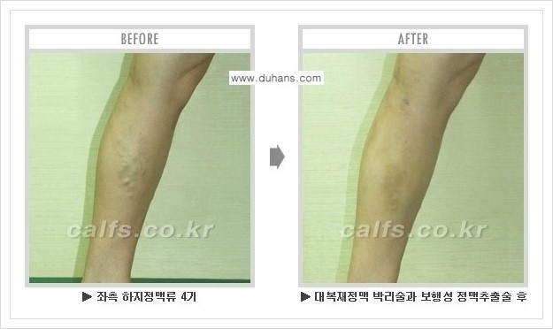 [두한성형외과 경쟁력 정맥류 치료] - [하지정맥류 사진 자료 안내 1.] 관련 이미지 15