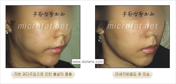 ​​​​[두한성형외과 경쟁력 미세지방이식] - [지방이식 부작용 - 지방이식 과다주입, 과다생착의 얼굴 모양에 대한 안내] 관련 이미지 2