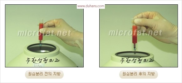 [두한성형외과 경쟁력 안면윤곽 교정] - [자연스럽고 균형있는 턱으로의 복원 미세지방이식과 간편 사각턱 보톡스 안내] 관련 이미지 9